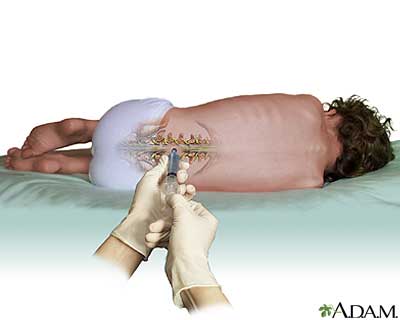 The ASO drug was injected into ALS patients' cerebrospinal fluid in a process similar to a lumbar puncture or spinal tap. Not exactly a walk in the park, but a bit easier than brain surgery, which may be needed for other 'flavors' of gene silencing.  
