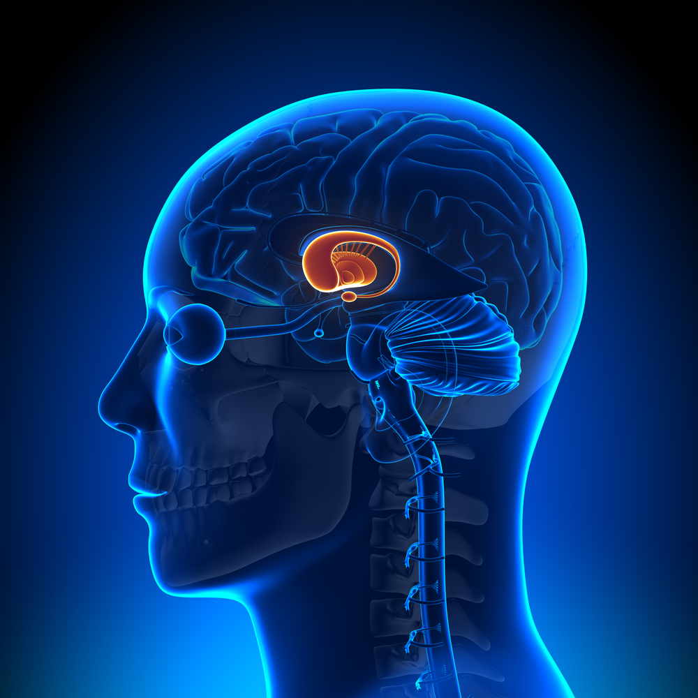AMT-130 will be injected into a deep part of the brain called the striatum, shown here in orange. The striatum is affected early in HD, but will the virus spread the huntingtin-lowering treatment far enough to produce benefits for patients?