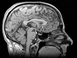 TRACK-HD använde kraftfulla MR-scannrar för att få detaljerade bilder av hjärnan hos frivilliga deltagare  