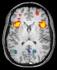 Ett exempel på hur en fMRI undersökning kan se ut - delar av hjärnan som är aktiva vid ett givet tillfälle (röda) kan särskiljas från mindre aktiva områden (blåa).  